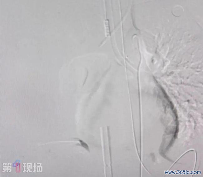 女子漂流呛水后吐血被确诊罕见病 命悬一线终获救